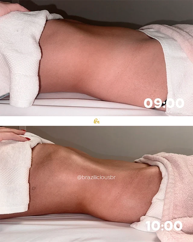 Before and After - Brazilian Body Lymphatic
