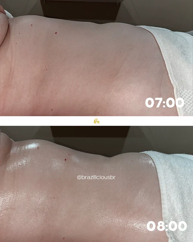 Before and After - Brazilian Body Lymphatic
