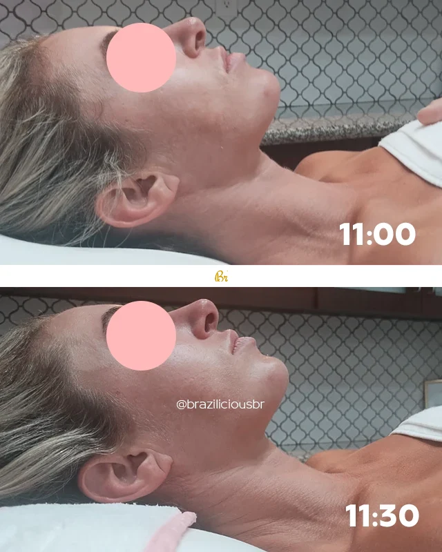 Before and After - Brazilian Face Lymphatic