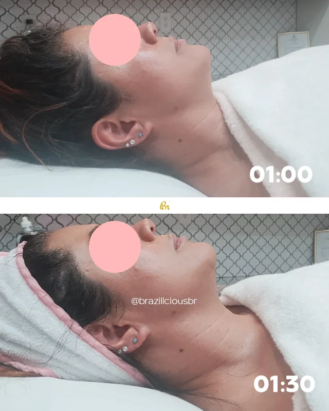 Before and After - Brazilian Face Lymphatic