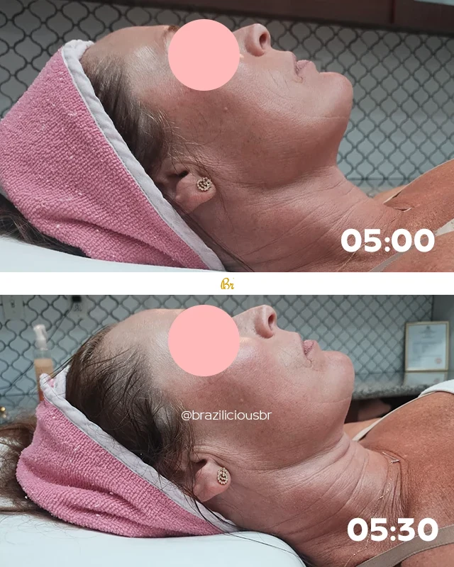 Before and After - Brazilian Face Lymphatic