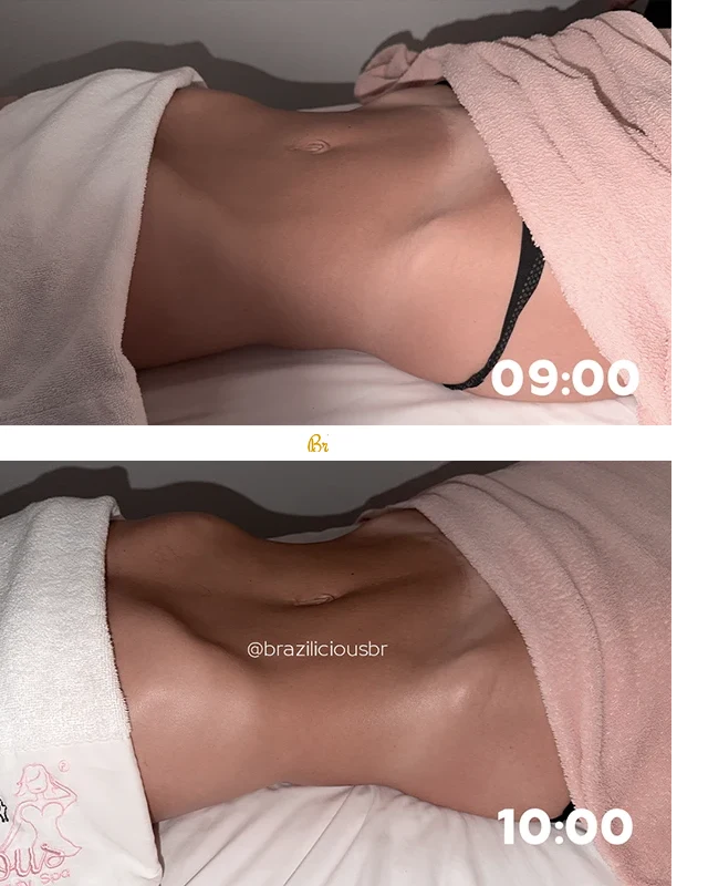 Before and After - Brazilian Body Lymphatic