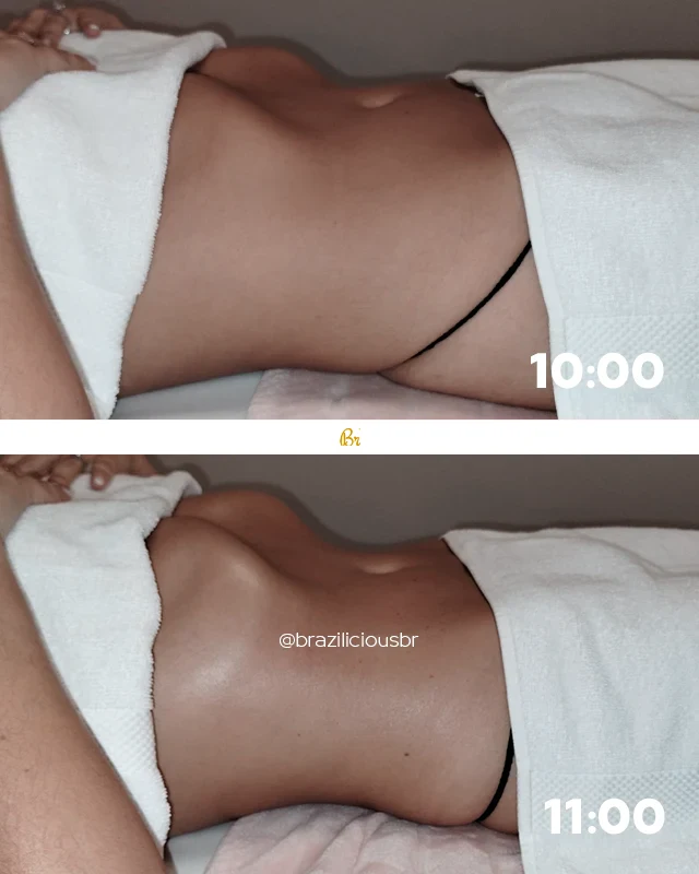 Before and After - Brazilian Body Lymphatic