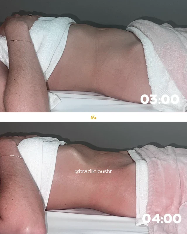 Before and After - Brazilian Body Lymphatic