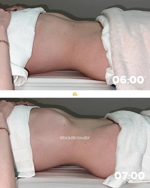 Before and After - Brazilian Body Lymphatic