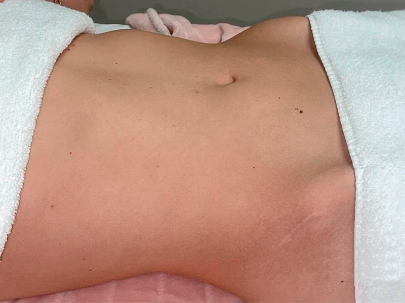 Before - Authentic Brazilian Lymphatic in Austin, TX